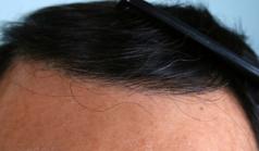 Before Hair Transplant&nbsp;Front